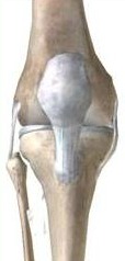 Total Knee Replacement